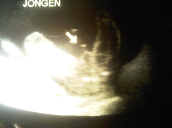 Geslacht Foto vd 20 weken echo kan niet mis zijn toch?