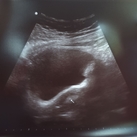 Echo terugplaatsing De allereerste echo.  3 dagen oud