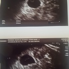 Echo week 5 23 Juni 2020 me eerste echo gehad, het hartje klopt 