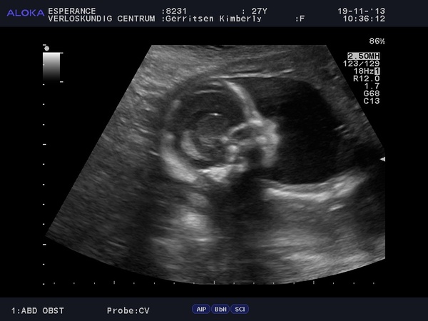 20 wk echo. 