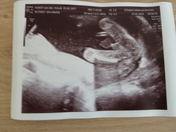 Echo foto van ons mannetje met 18 wk en 5 dg 