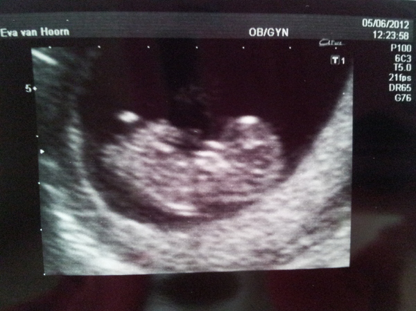 baby janssen  