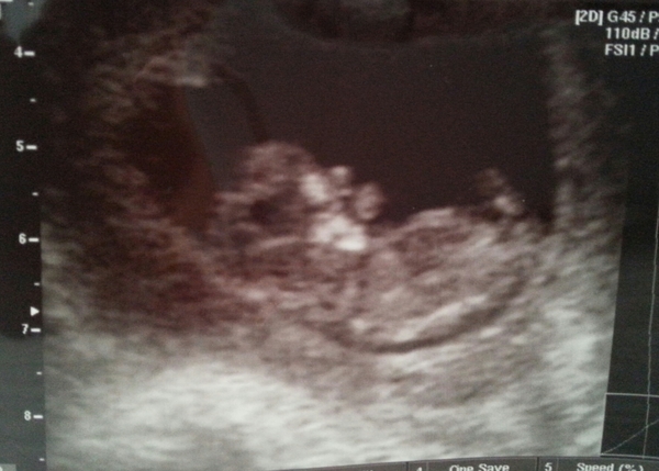10w5d ♡♥
