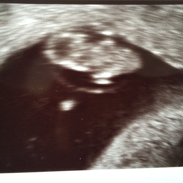 Echo bij 8,5 week