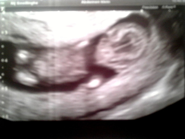 11 weken en drie dagen echo. We zijn zo blij met ons eerste kindje na, 7 iui-, 3 ivf pogingen en één miskraam ! 