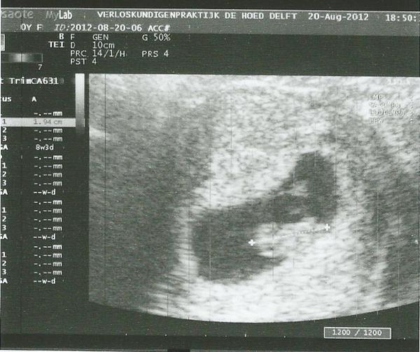 Eerste echo :D De eerste echo, gekregen op 9 weken zwangerschap. maar de termijn was niet goed via de echo te bepalen. Dat komt bij de volgende :D