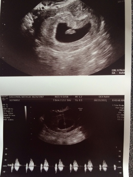 6w5d Eerste echo