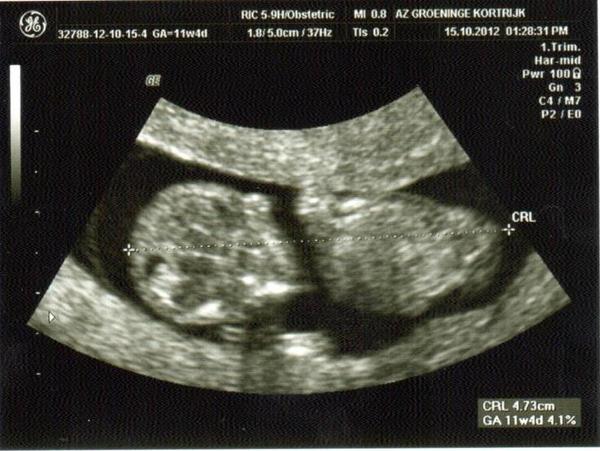  baby 11 w 4d