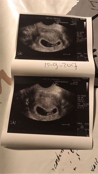  Mijn eerste echo!!
Wat was ik trots dat ik zag dat er een kindje in me groeit en dat het hartje klopte!! 
Nu wachten op de tweede echo 