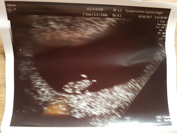 Eerste echo wurmpje De eerste echo om te kijken hoe ver ik ongeveer ben. 6.3 week. 