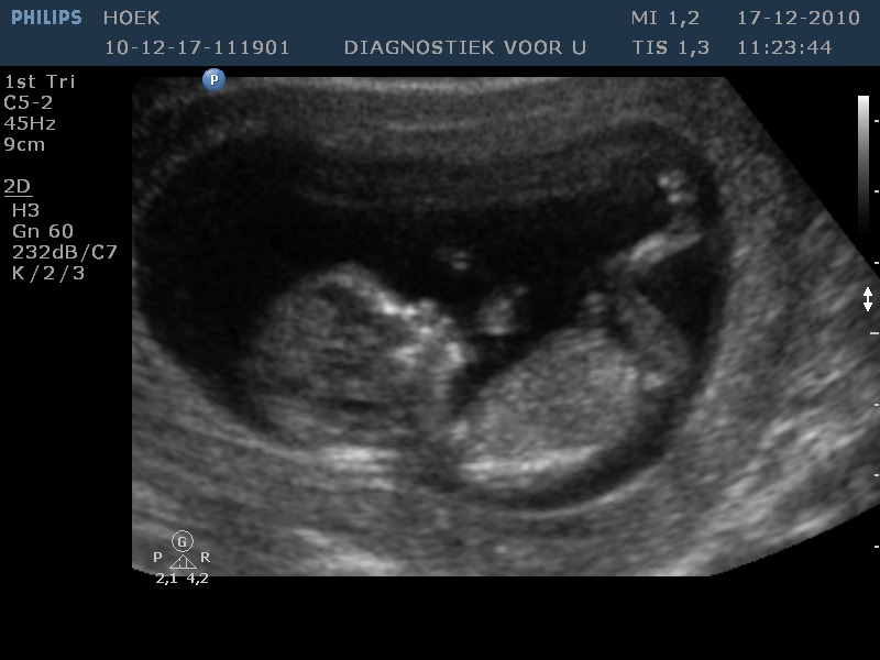 12 weken echo hier is ons meisje 13 weekjes :D