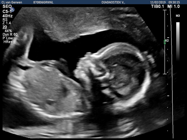 19+2 20wkn echo Alles is goed met ons meisje (L)