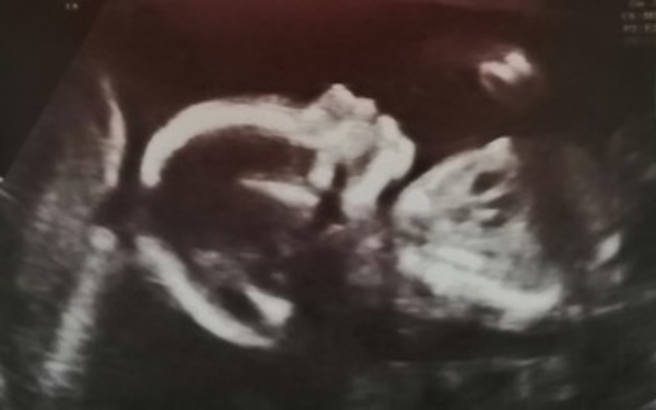 20 weken echo 19w2d <3