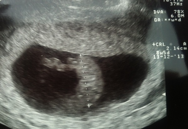 Ons wondertje met 8 weken en 5 dagen 