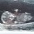 Ons wondertje &hearts; Echo van 11 weken en 3 dagen &hearts;