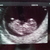 baby janssen  