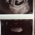 6w5d Eerste echo