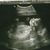 Ons wondertje 20 weken echo