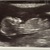  13w 2d echo. 