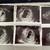 zwanger <3  4 foto's aan de linkerkant zijn van de echo van afgelopen maandag 24-05-2021
2 foto's aan de rechterkant zijn van de spoed echo op 15-05-2021