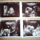Echo foto's van ons mannetje met 18 wk en 5 dg 