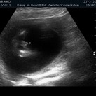 het is goed kijken maar daar is onze zoon <3 Echo bij 17 week en 1 dag. gemaakt door baby in beeld