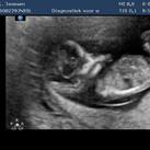 12 wk 4 dg  