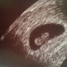 7.1 weken Gezond snel kloppend hartje gezien. Het kindje was 9,9 mm groot.