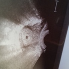 1e echo Vandaag de 1e echo gehad. Vruchtzakje + piepklein vruchtje gezien. 4 weken + 4 dagen zwanger.