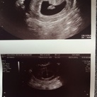 6w5d Eerste echo