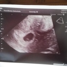 6 weken zwanger Echo bij 6 weken zwangerschap 