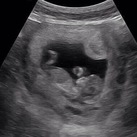 12w1d 