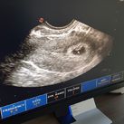 Eerste echo 