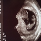  Acardiatic twin :( 