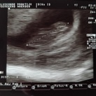 9.2 weken Eerste echo op 9.2 weken zwanger.