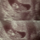 Echo 3 bij 10w1d Extra echo ivm helderrood bloedverlies. Gelukkig zag alles er nog goed uit. Kloppend hartje en de baby bewoog zelfs een beetje <3 wat een opluchting dat alles goed is. 