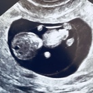  Echo bij 9 weken en 6 dagen 