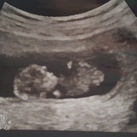  11 weken en 4 dagen zwanger, wat zegt nub theorie over de foto ben erg benieuwd!