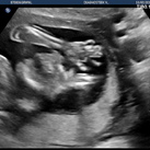 19+2 20wkn echo Even zwaaien naar papa en mama (L)
Een handje met 5 vingertjes.