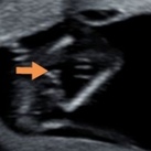 Kunnen jullie het geslacht zien?  Kunnen jullie wijs uit deze echo's? 15.1 week een echo gehad, maar ze konden het niet goed zien vanwege de ligging op de buik... Ze dacht een jongen, maar mijn verloskundige twijfelt en ziet niet iets van een jongen... Alvast bedankt