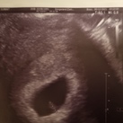 Is er een embryo  Dit was heel spannend, we waren een week ervoor geweest, toen was er alleen een vruchtzakje, en moesten we over een week terug komen. En nu positief nieuws